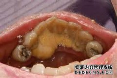 如何清除牙齿上的石头